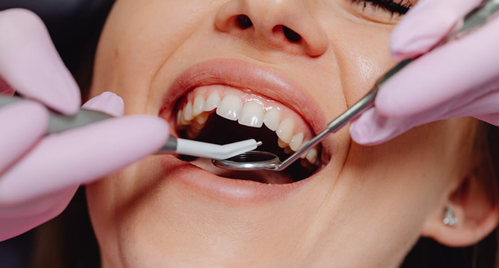 Gum Treatment in Indore: How to Prevent and Treat Gum Disease